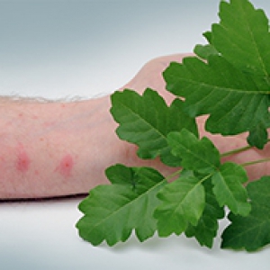 a pale arm with spots from poison oak
